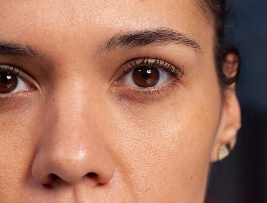 How To Remove Dark Circles – A Complete Guide