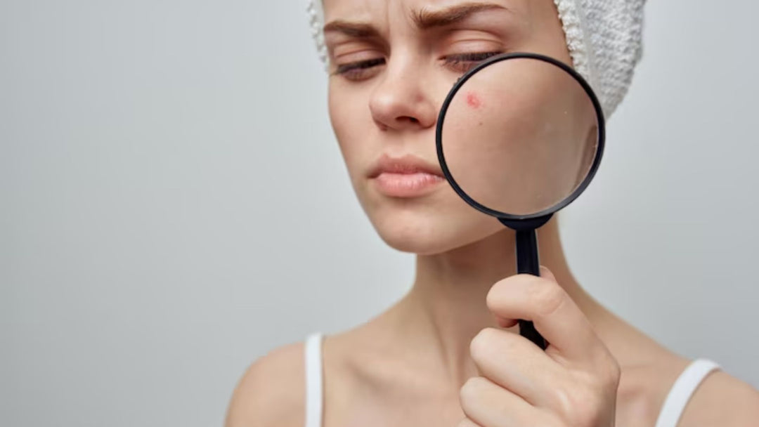 What Is The Difference Between Acne & Pimples